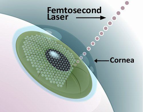 Femtosecond laser – chữa tật khúc xạ nhanh, an toàn, hiệu quả